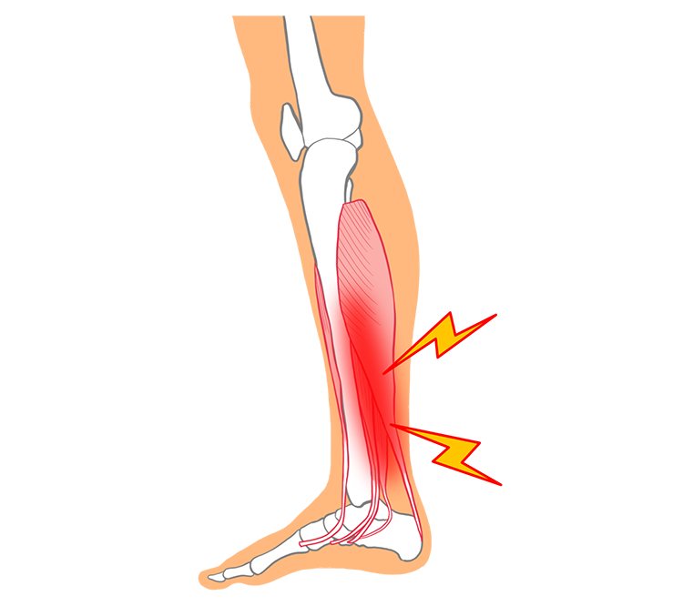 シンスプリント