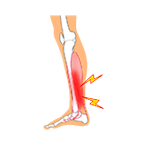 スポーツによる痛み